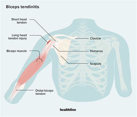 Biceps/Triceps tendon injuries